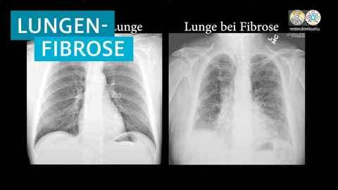 Lungenfibrose