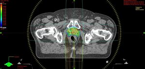 Stereotaktische Strahlentherapie der Prostata