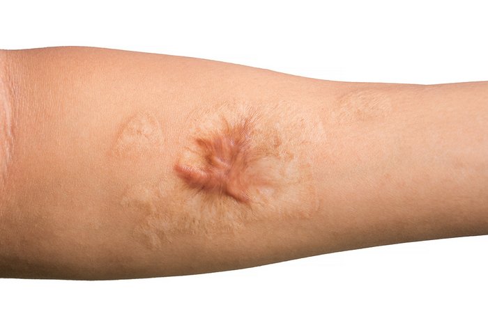 Narbe von Verbrennung auf Arm