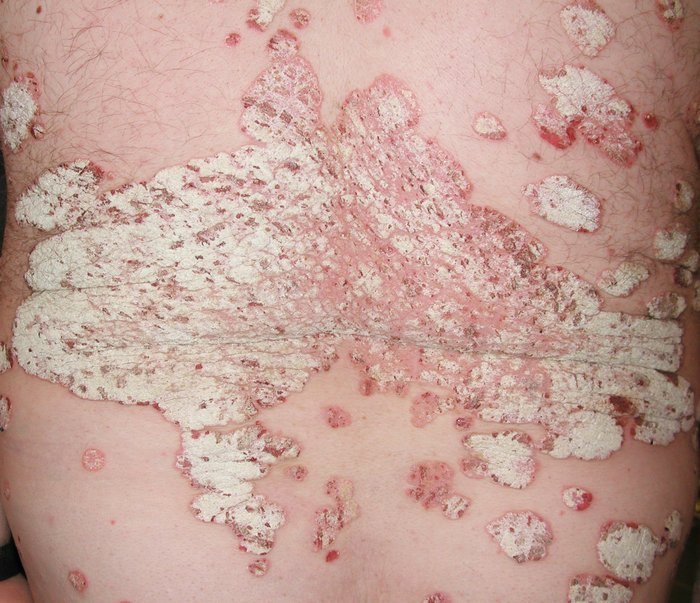 Psoriasis vulgaris