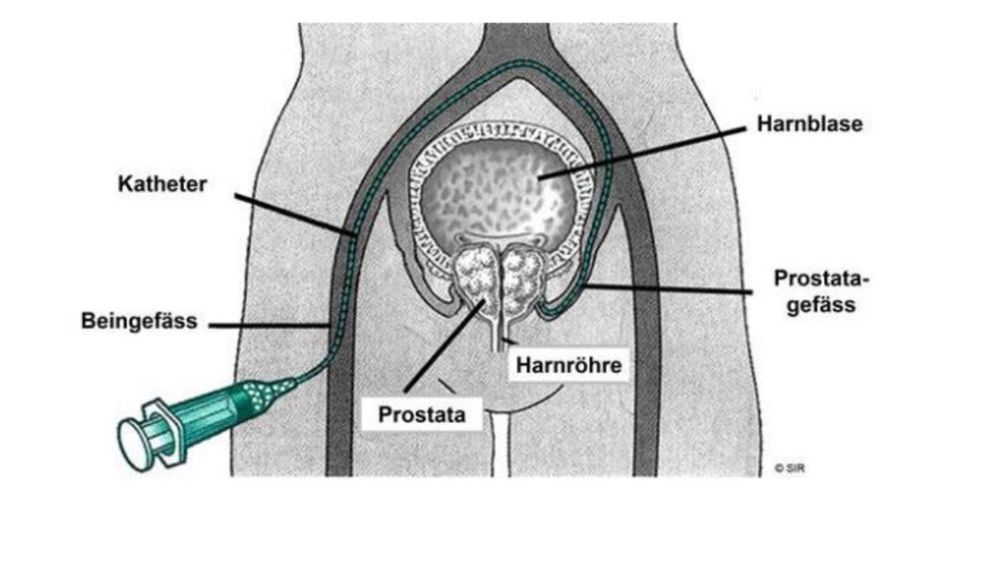 ProstataArterienEmoblisation Neues Verfahren schrumpft Prostata Ordensklinikum