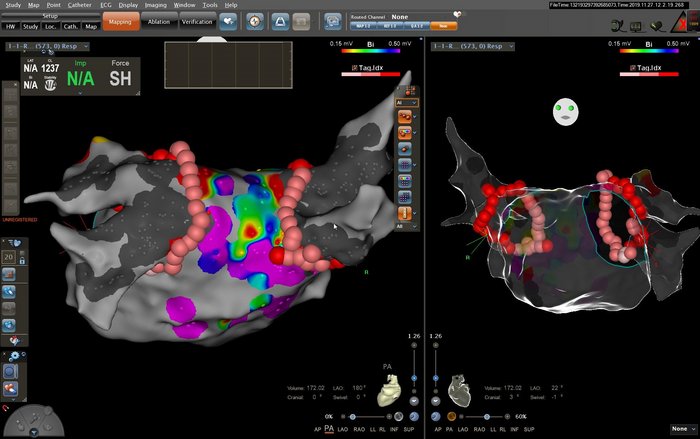 3D-Darstellung des linken Vorhofes und der Ablationen im Rahmen einer Pulmonalvenenisolation bei Vorhofflimmern