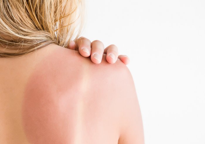Sonnenbrand