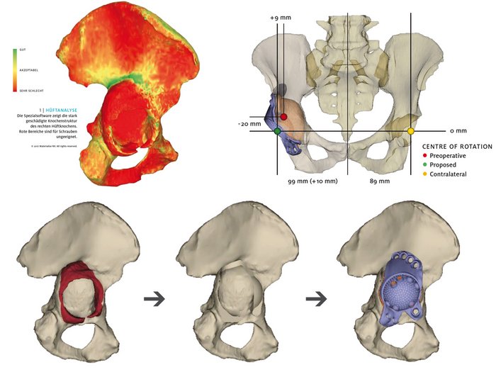 3D Hüftprothese