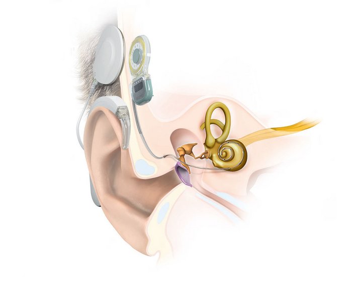 Cochlea Implantat