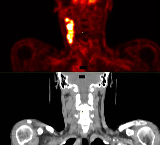 Ausgeprägte Lymphknotenmetastasierung bei HPV-positivem Oropharynxkarzinom